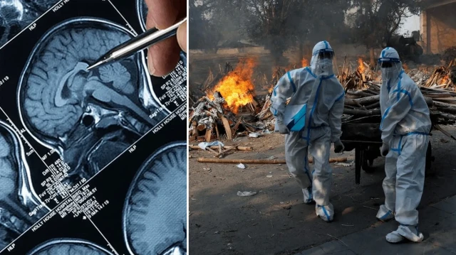 hindistanda beyin yiyen amip alarmi burundan giriyor yavas yavas beyni yiyor SnQOgblA